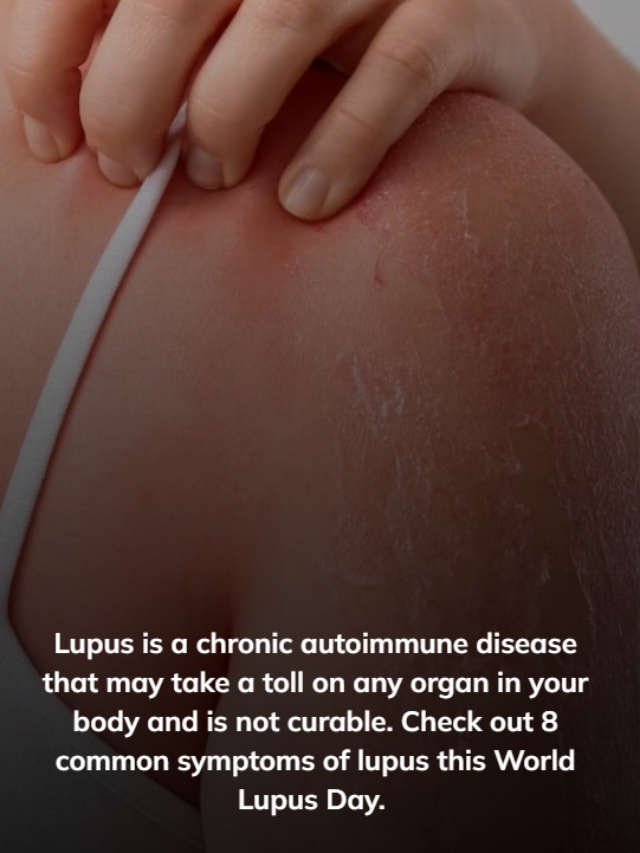 Unveiling Lupus: Recognizing 8 Key Symptoms for Early Detection