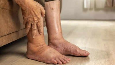 Pancreatic cancer: 4 warning signs in your legs that you shouldn’t ignore |