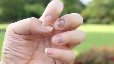 6 warning signs in the nails one should not ignore: They could be indicating serious health issues |