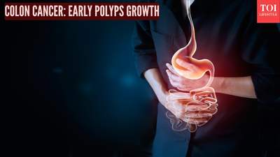 Colon Cancer: Doctor explains how early polyps grow quietly and how screening saves lives |