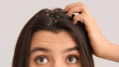Dandruff is more than just poor hygiene; know what your scalp is telling you |