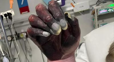 Mother dies after arm amputation as doctors dismiss blackened hand as ‘newspaper ink’ |