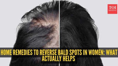 Alopecia Areata remedies: Home remedies to reverse bald spot in women