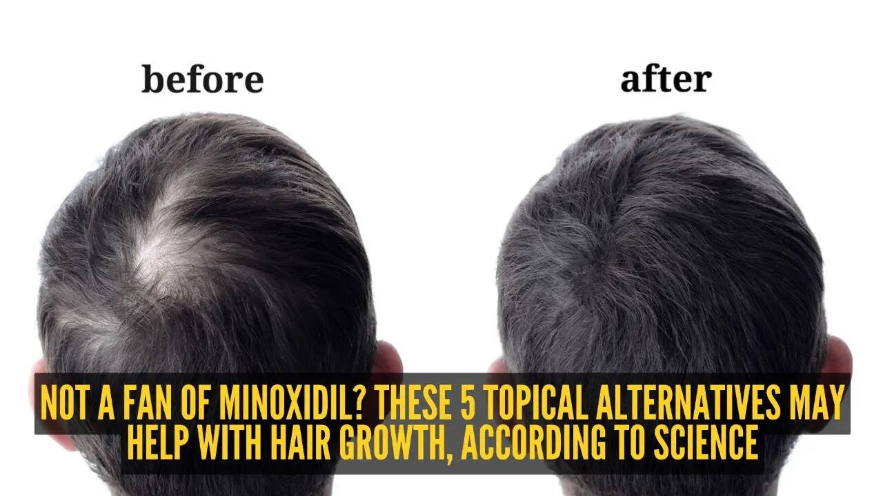 5 topical minoxidil alternatives to increase hair growth
